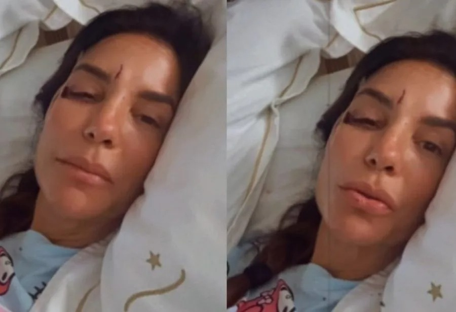 Ivete Sangalo surge com olho roxo após desmaiar e ser internada em hospital de Salvador